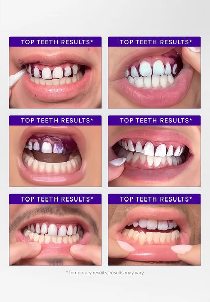 Hismile V34 Whitening Strips