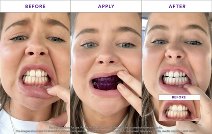 Hismile V34 Whitening Strips